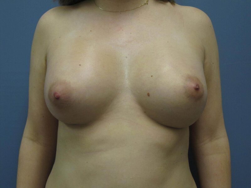 After — Breast Augmentation