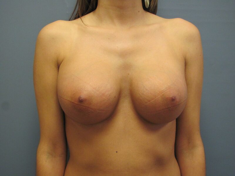 After — Breast Augmentation