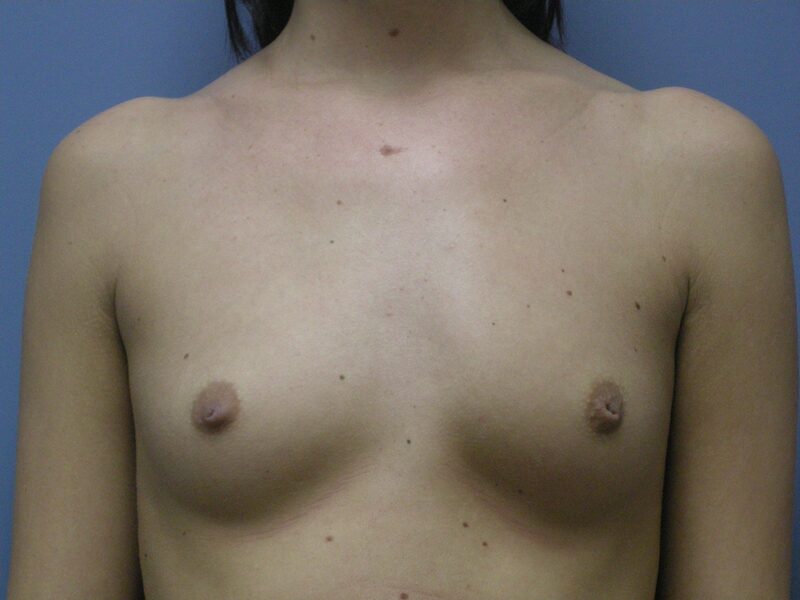 Before — Breast Augmentation