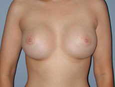 After — Breast Augmentation