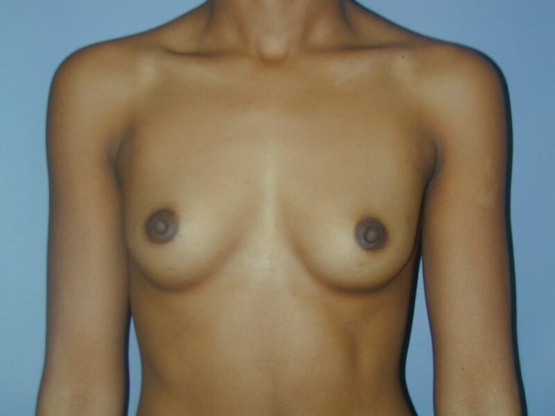 Before — Breast Augmentation