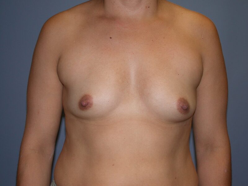 Before — Breast Augmentation