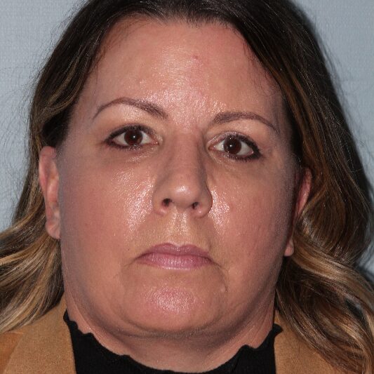 After — 51 year old woman treated with Neck Lift