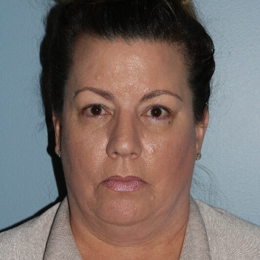 Before — 51 year old woman treated with Neck Lift