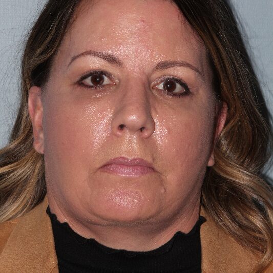 After — 51 year old woman treated with Facelift