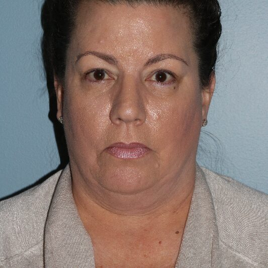 Before — 51 year old woman treated with Neck Liposuction
