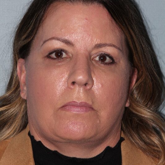 After — 45-54 year old woman treated with Lifestyle Lift
