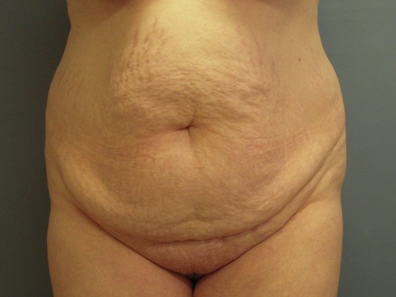 Before — Tummy Tuck, Abdominoplasty