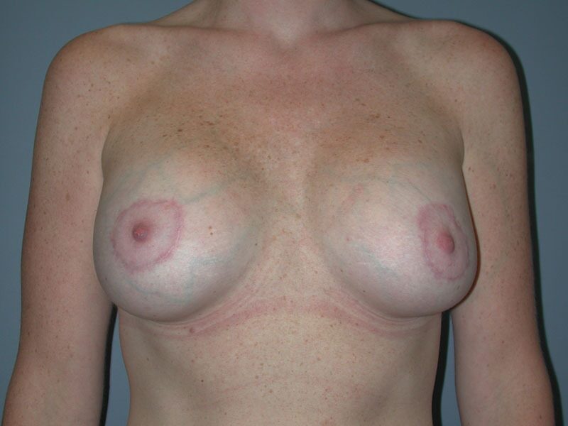 After — Breast Augmentation, Breast Implants