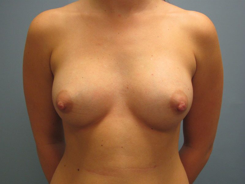 Before — Breast Augmentation