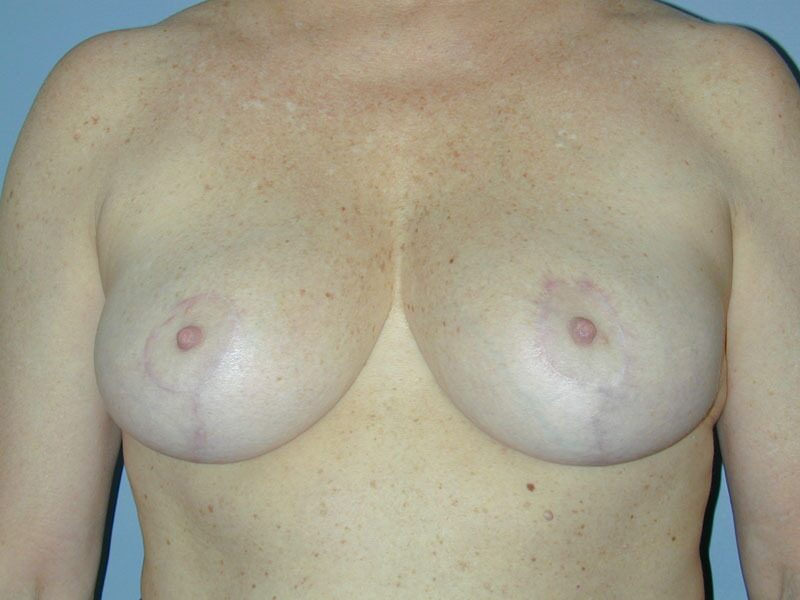 After — Breast Reduction 