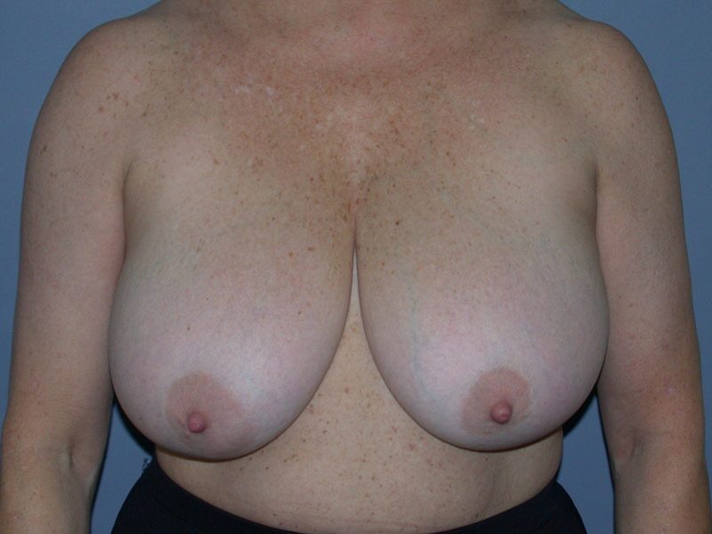 Before — Breast Reduction 