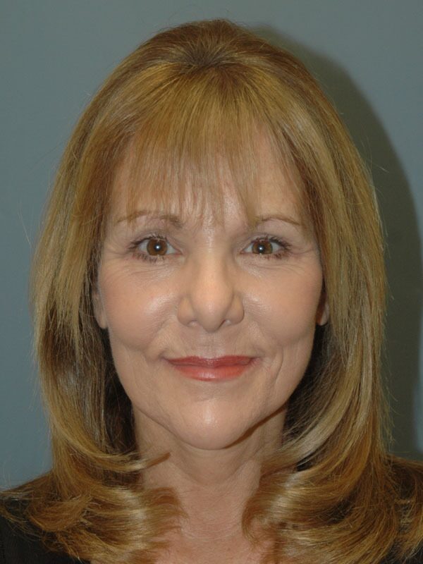 After — Facelift 