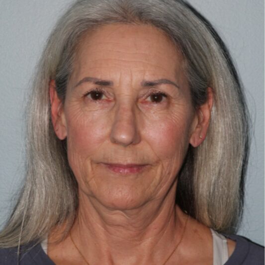 Before — 64 year old woman treated with a Facelift