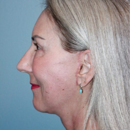 After — 64 year old woman treated with Eyelid Surgery