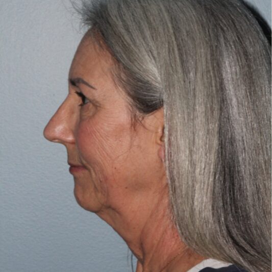 Before — 64 year old woman treated with Eyelid Surgery