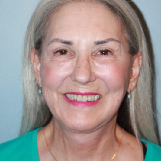 After — 64 year old woman treated with Facial Fat Transfer