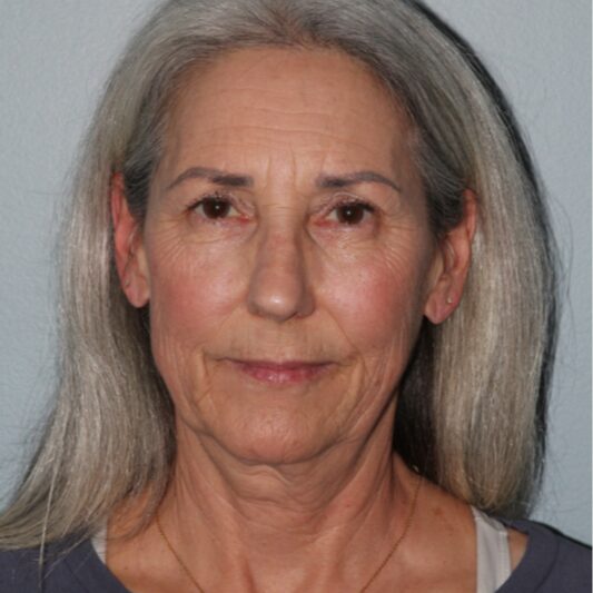 Before — 64 year old woman treated with Lower Face Lift