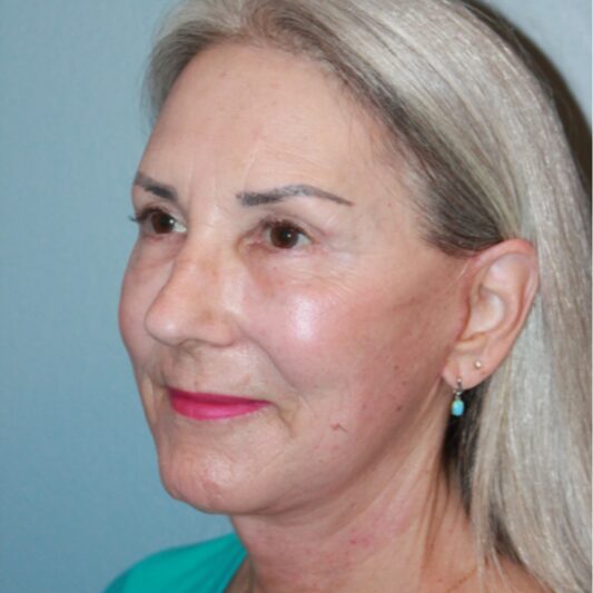 After — 64 year old woman treated with Lifestyle Lift like facelift