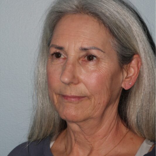 Before — 64 year old woman treated with Lifestyle Lift like facelift