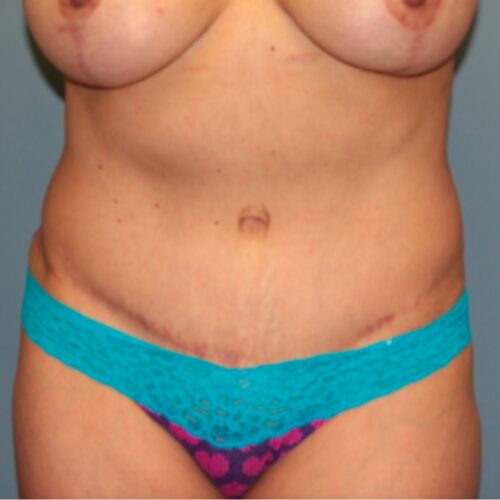 After — 55-64 year old woman treated with Tummy Tuck