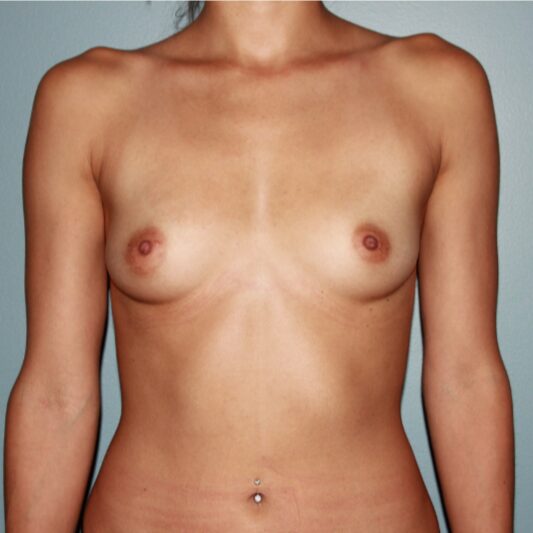Before — 27 year old woman treated with Breast Augmentation