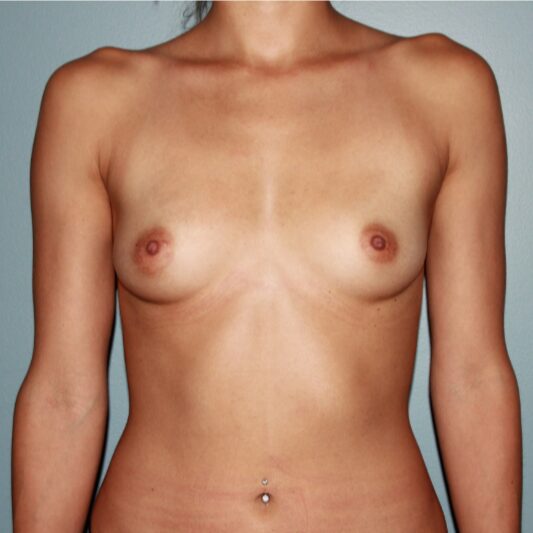 Before — 27 year old woman treated with Ideal Implant