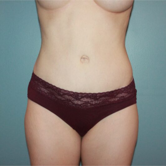 After — 32 year old woman treated with Diastasis Recti Repair