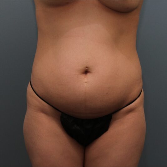 Before — 32 year old woman treated with Diastasis Recti Repair