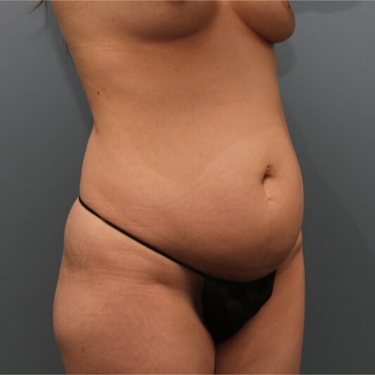 Before — 32 year old woman treated with Diastasis Recti Repair