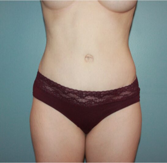 After — 32 year old woman treated with Tummy Tuck