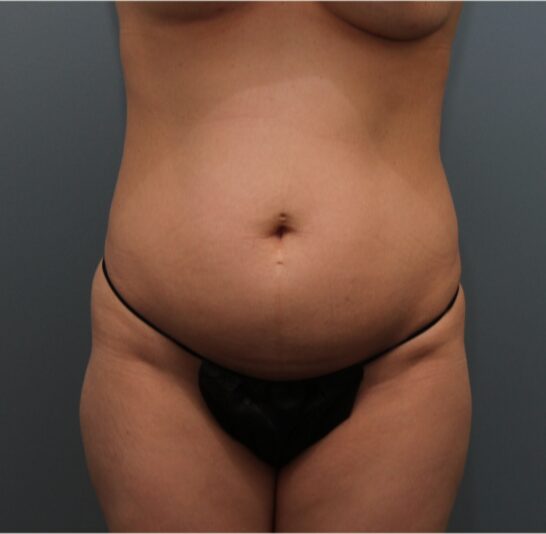 Before — 32 year old woman treated with Tummy Tuck
