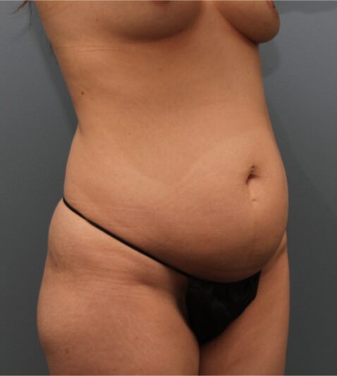 Before — 32 year old woman treated with Mommy Makeover