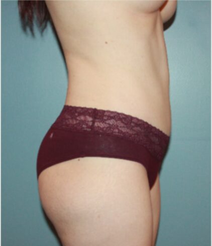 After — 32 year old woman treated with Mommy Makeover
