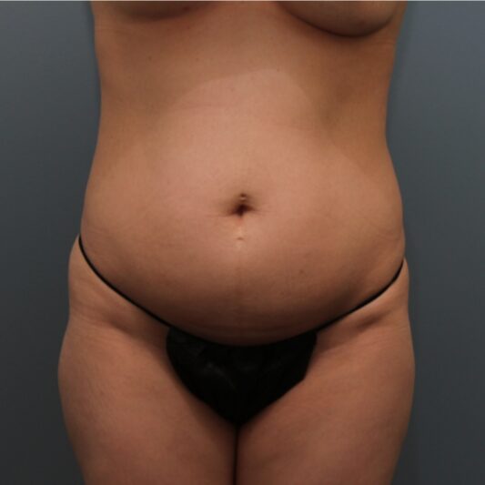 Before — 32 year old woman treated with a standard Tummy Tuck