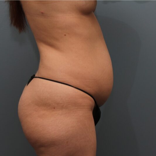 Before — 32 year old woman treated with Tummy Tuck