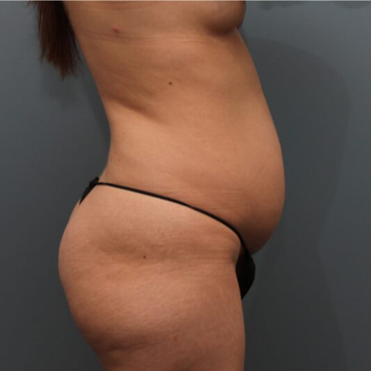 Before — 32 year old woman treated with Liposuction