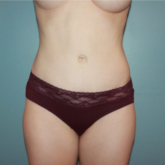 After — 32 year old woman treated with Vaser Liposuction