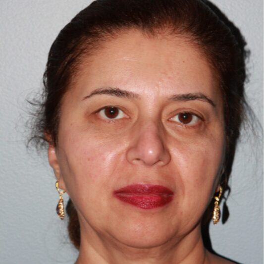 Before — 55 year old woman treated with Eyelid Surgery