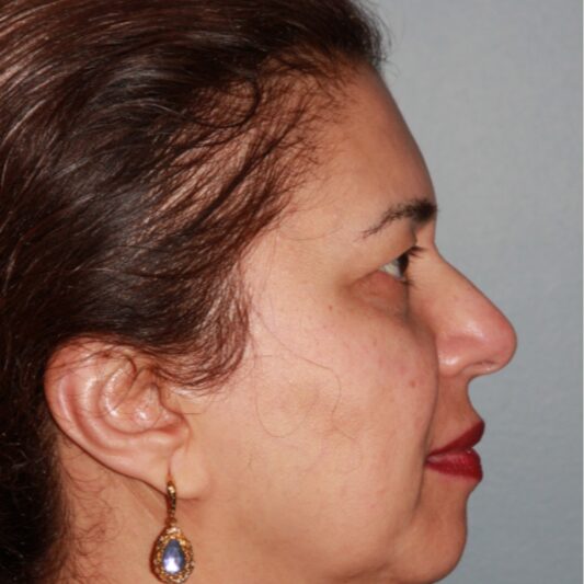 Before — 55 year old woman treated with Eyelid Surgery