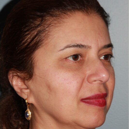 Before — 55 year old woman treated with Eyelid Surgery