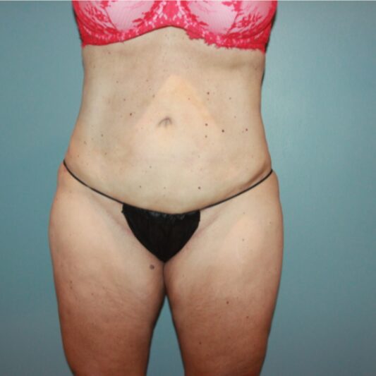 After — 50 year old woman treated with Liposuction