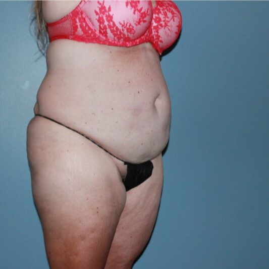 Before — 50 year old woman treated with Liposuction