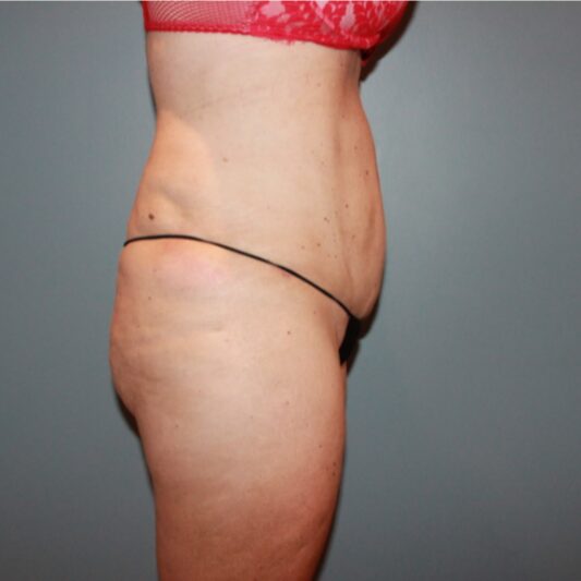 After — 50 year old woman treated with Liposuction