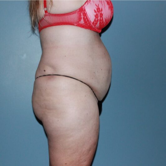 Before — 50 year old woman treated with Liposuction