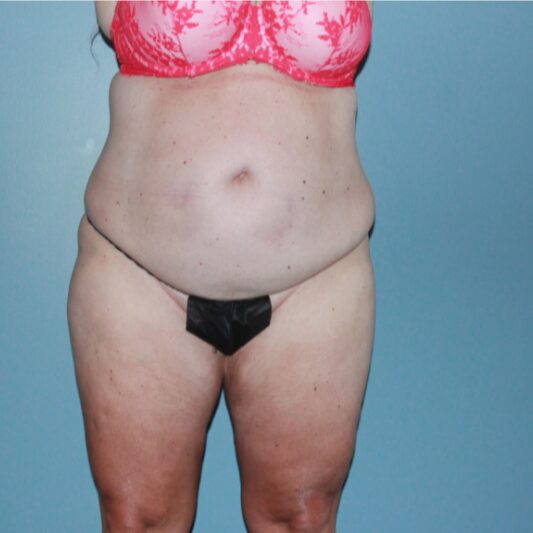 Before — 50 year old woman treated with Vaser Liposuction