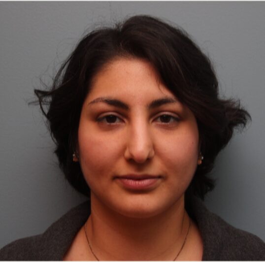 Before — 28 year old woman treated with Rhinoplasty