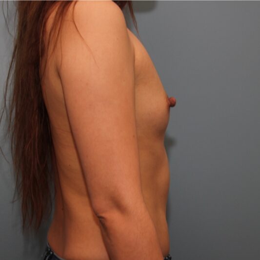 Before — 31 year old woman treated with Breast Augmentation
