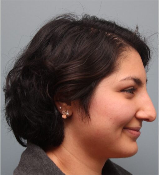 Before — 28 year old woman treated with Rhinoplasty