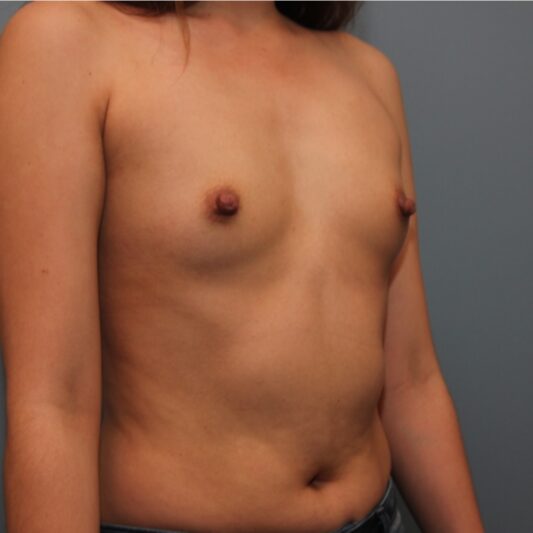 Before — 31 year old woman treated with Sientra Breast Implants